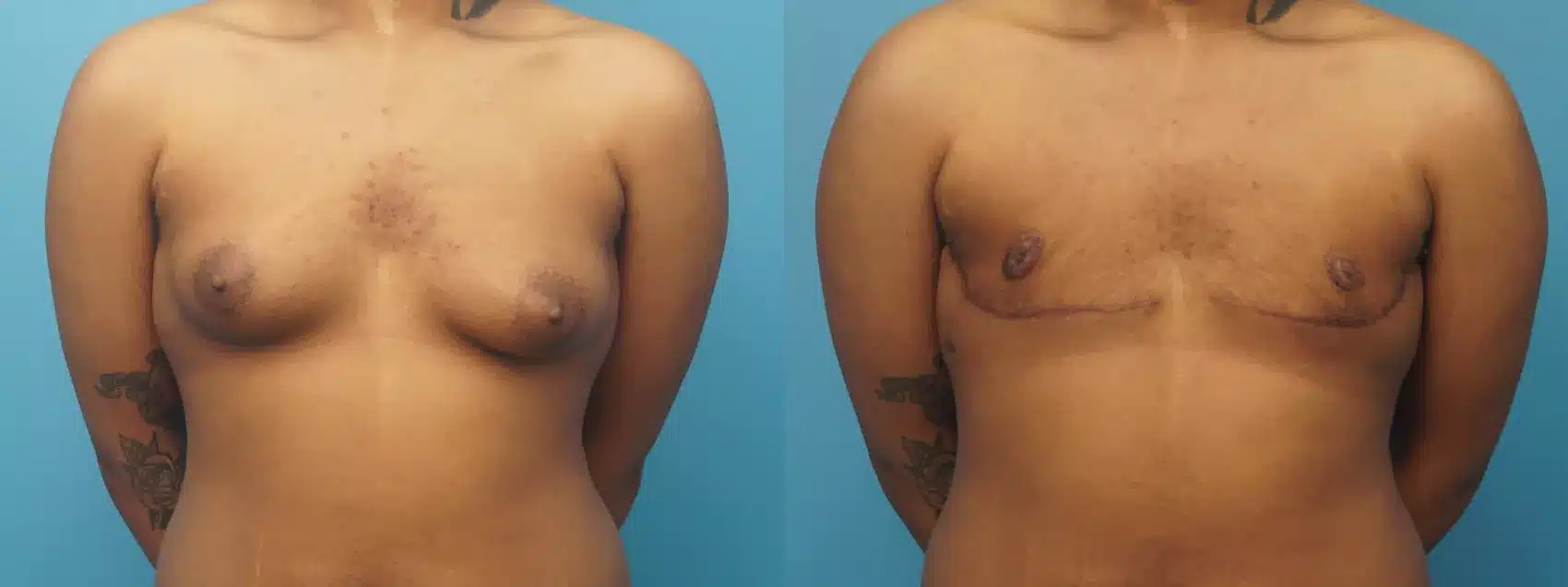 Before and After Image: Case #387 - front