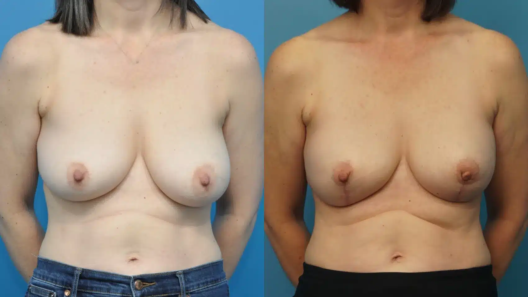 Before and After Image: Implant Mastectomy Reconstruction - front