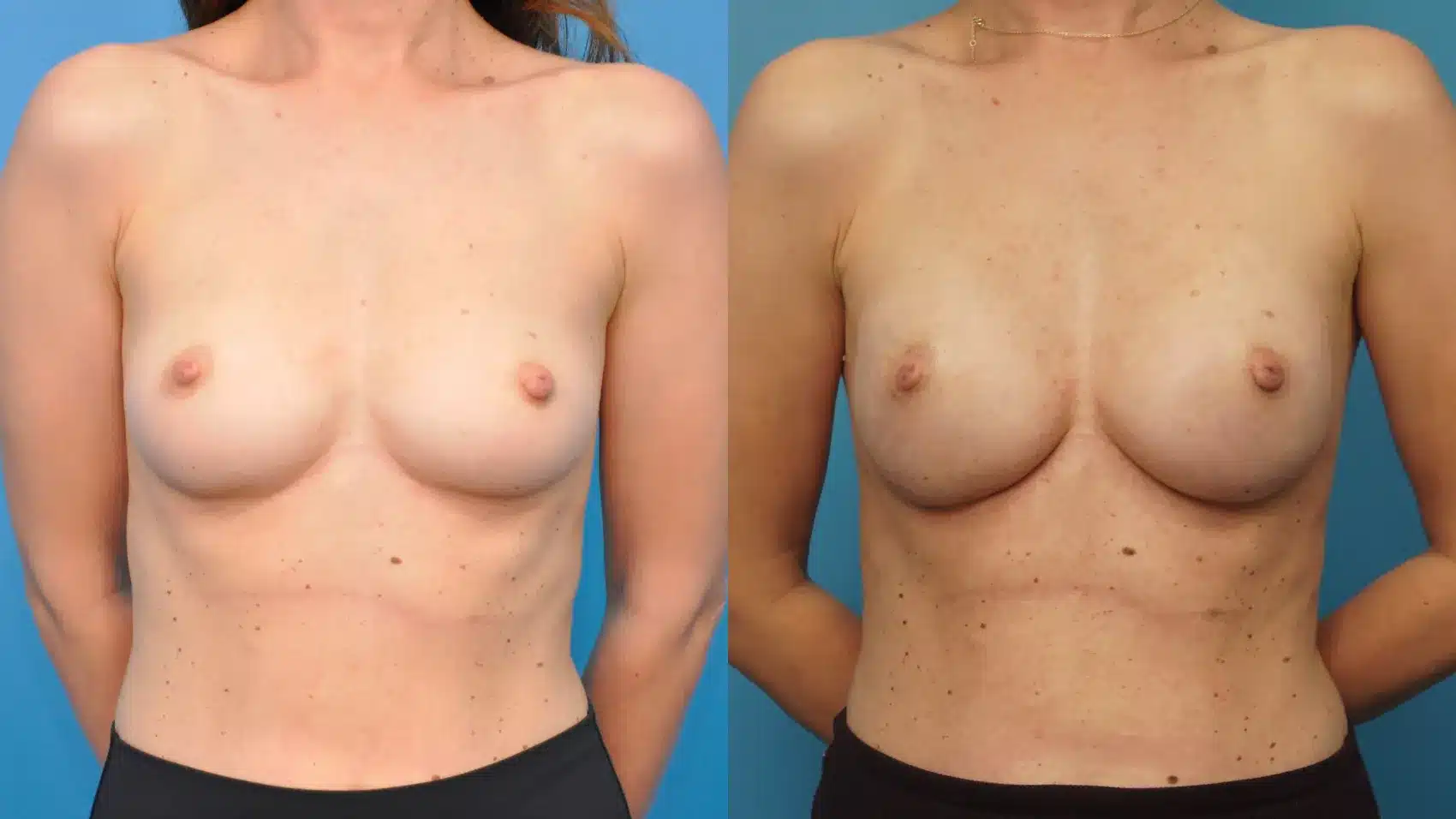 Before and After Image: Mastectomy Reconstruction with Implants - front