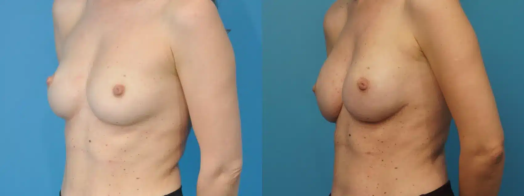 Before and After Image: Mastectomy Reconstruction with Implants - left-front-oblique