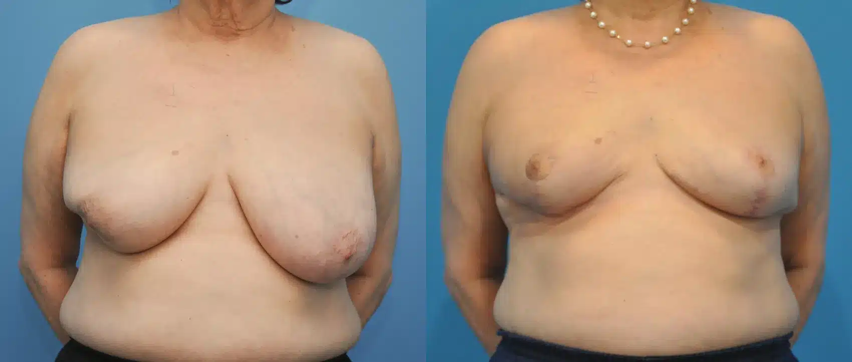 Before and After Image: Oncoplastic Surgery for Breast Cancer - front