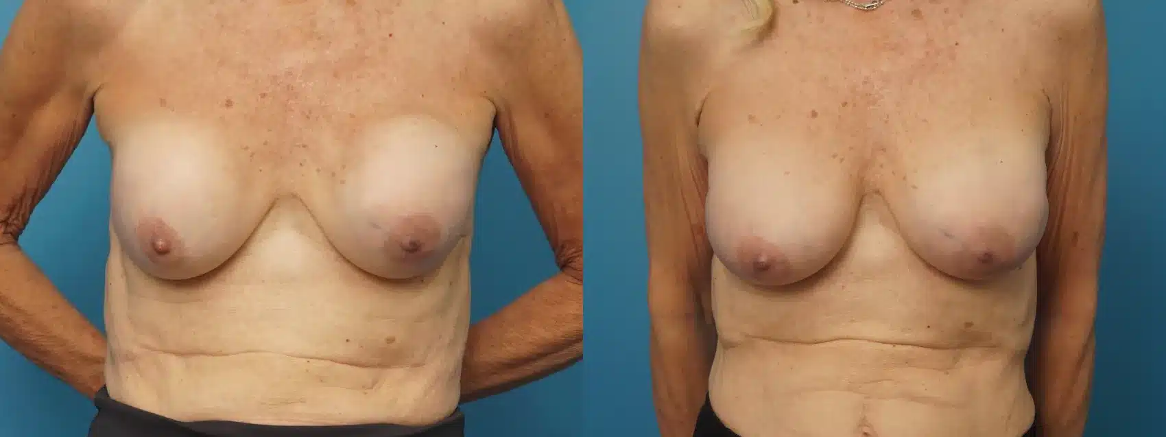 Before and After Image: Revision Breast Augmentation without Lift - front