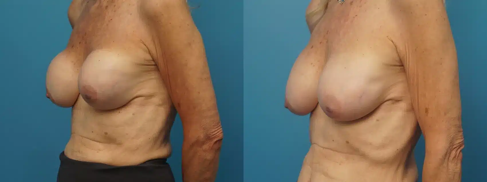 Before and After Image: Revision Breast Augmentation without Lift - left-front-oblique