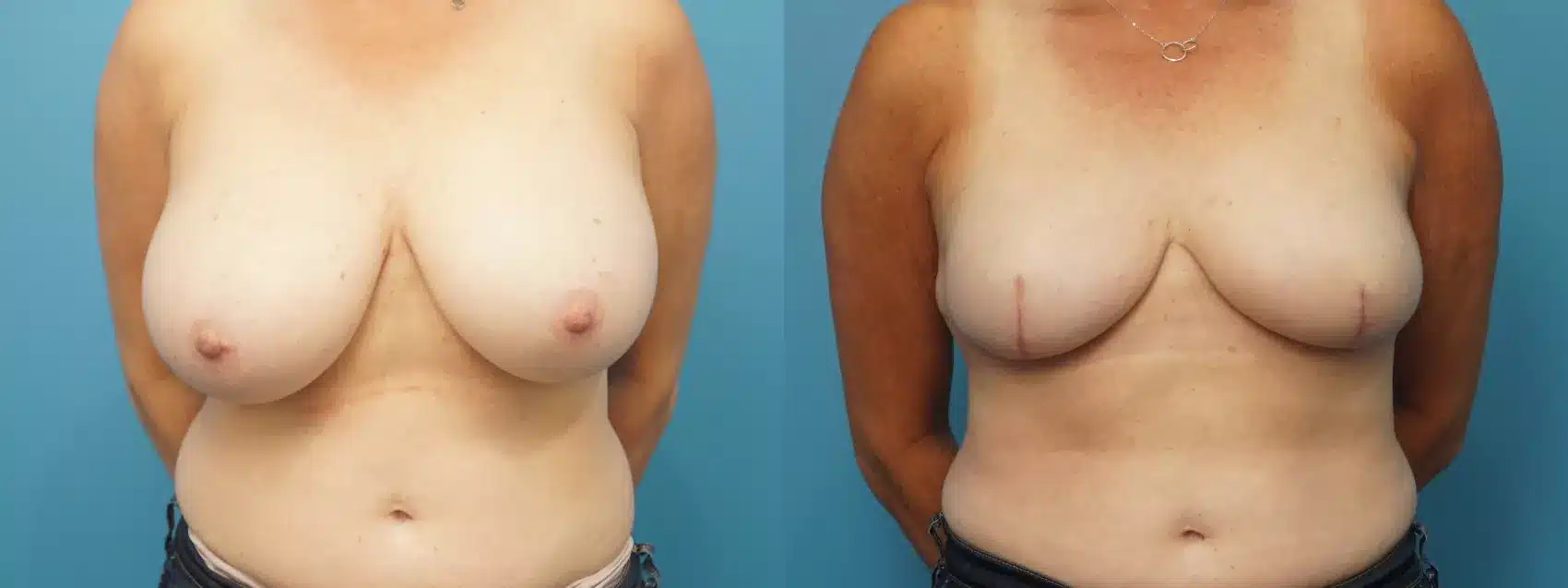 Before and After Image: Case #391 - front