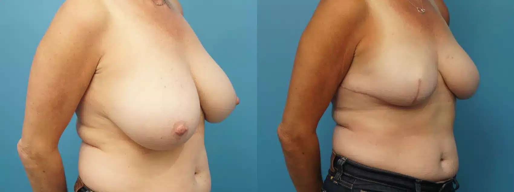 Before and After Image: Case #391 - right-front-oblique