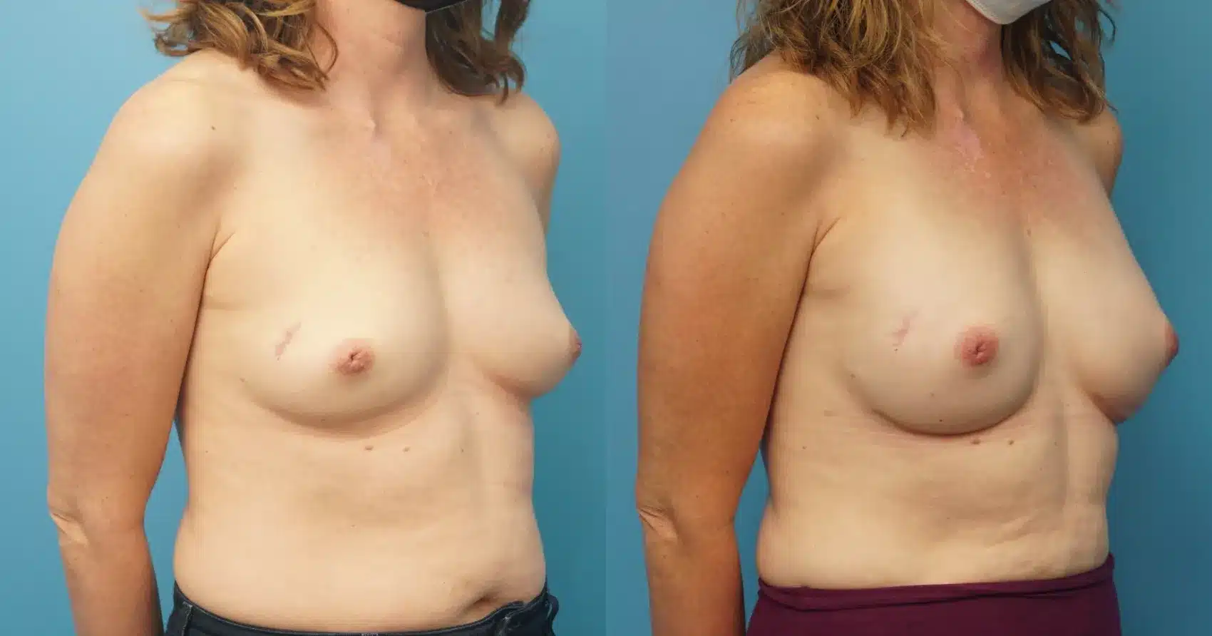Before and After Image: Implant Mastectomy Reconstruction - right-front-oblique