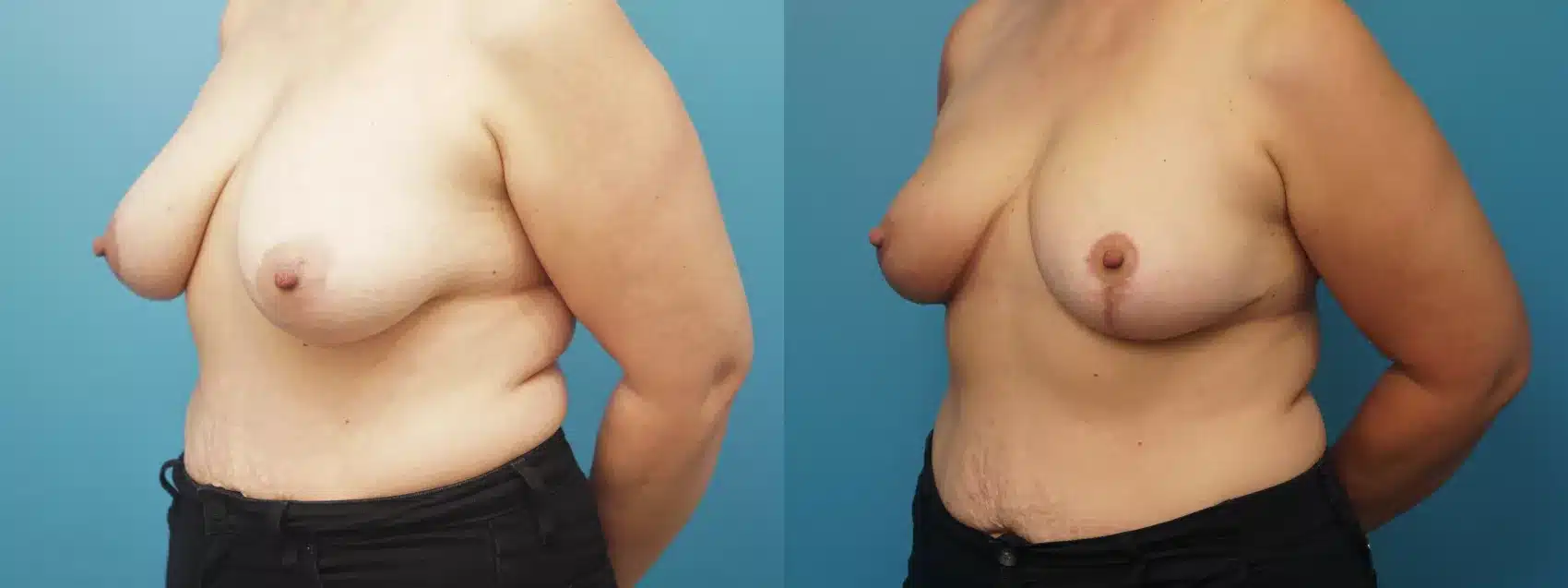 Before and After Image: Case #394 - left-front-oblique