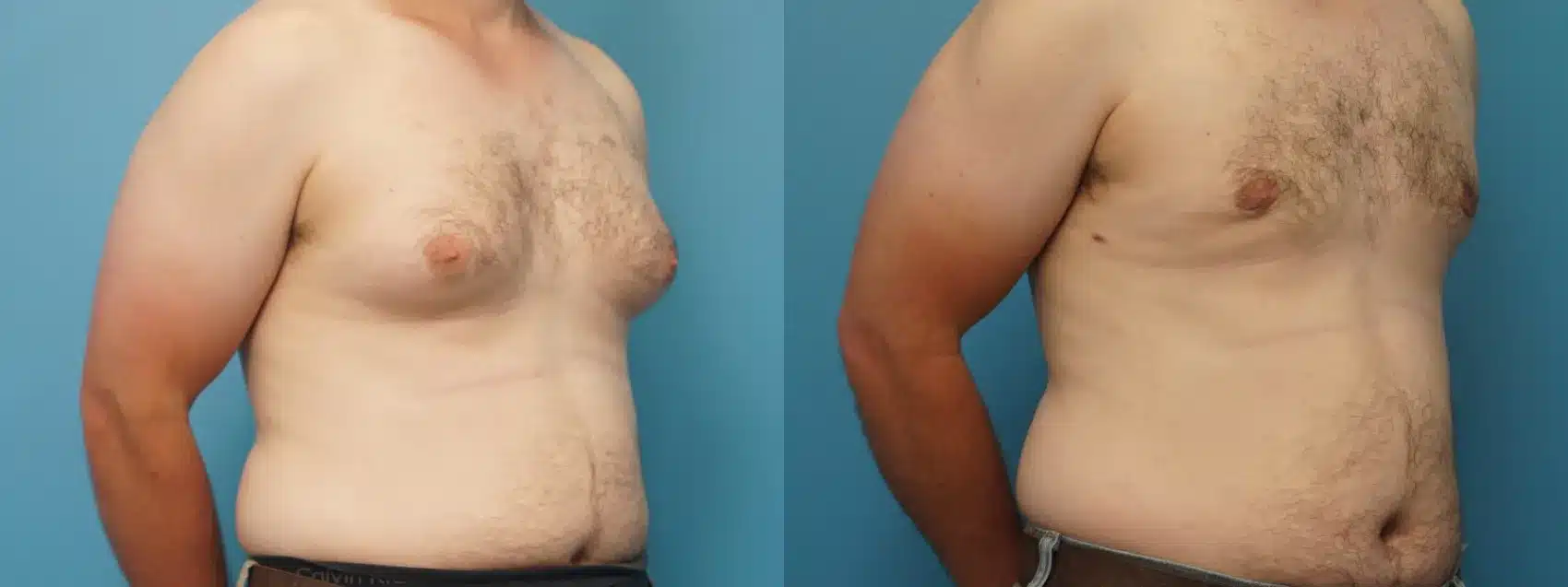 Before and After Image: Male Breast Reduction - right-front-oblique