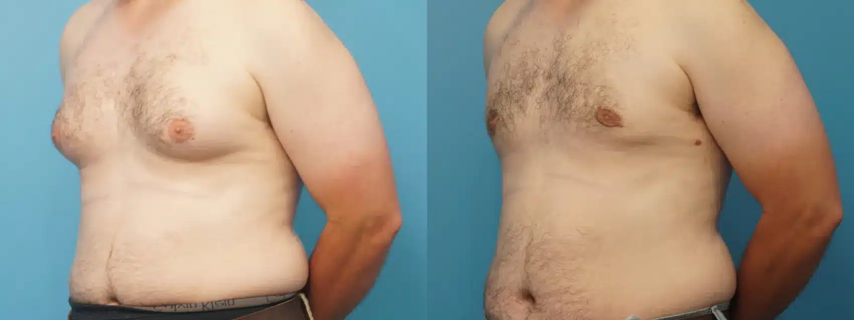 Before and After Image: Male Breast Reduction - left-front-oblique