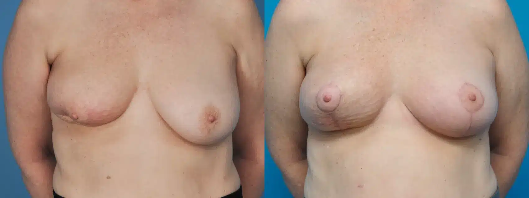 Before and After Image: Oncoplastic Surgery for Breast Cancer - front