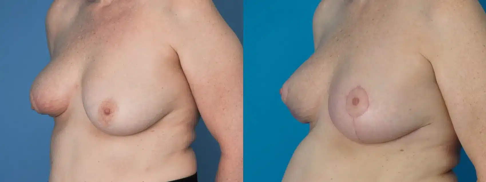 Before and After Image: Oncoplastic Surgery for Breast Cancer - left-front-oblique