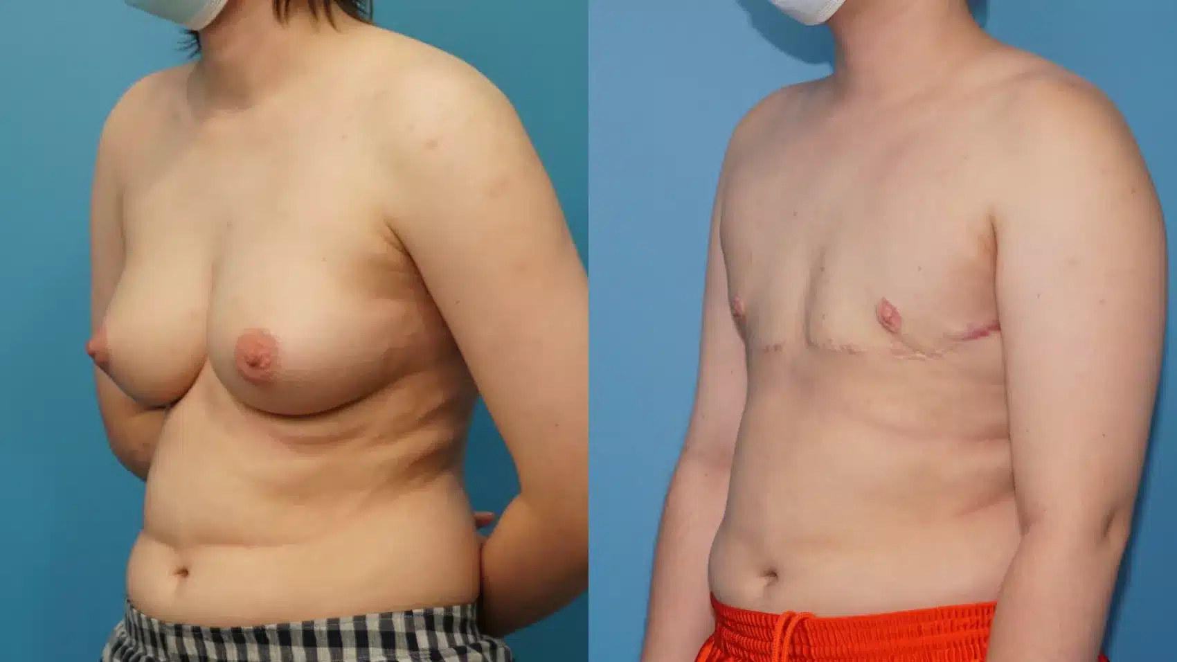 Before and After Image: Case #397 - left-front-oblique