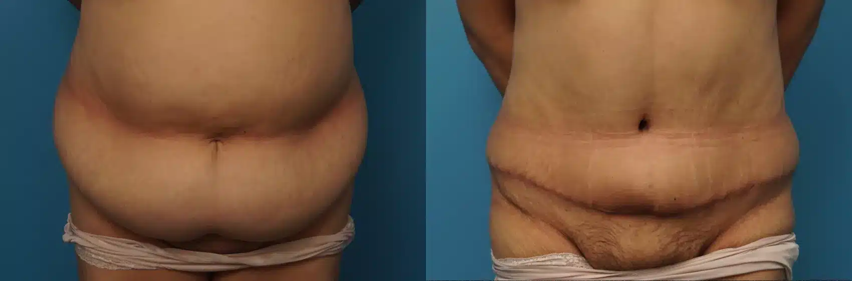 Before and After Image: Case #398 - front