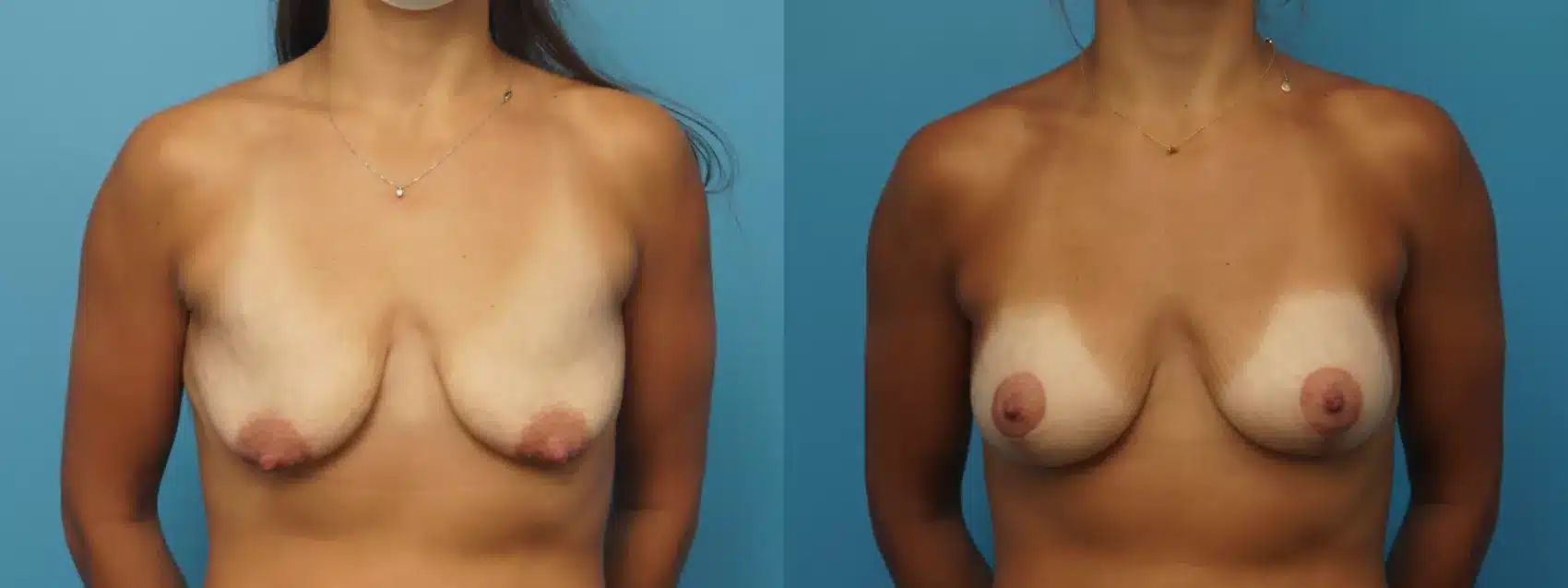 Before and After Image: Case #399 - front