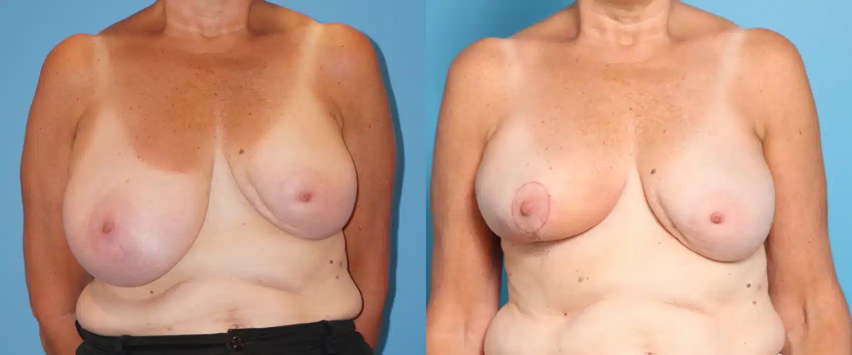 Before and After Image: Oncoplastic Surgery for Breast Cancer - front