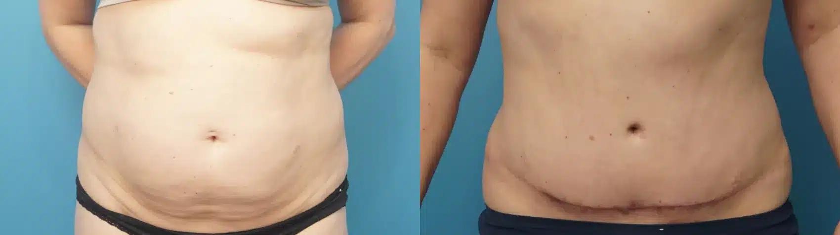 Before and After Image: Case #400 - front