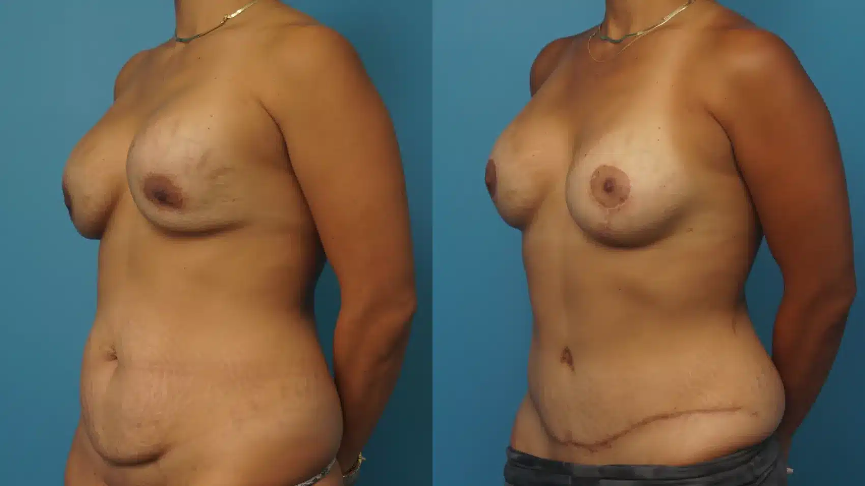 Before and After Image: Revision Breast Augmentation with Lift and Tummy Tuck - left-front-oblique