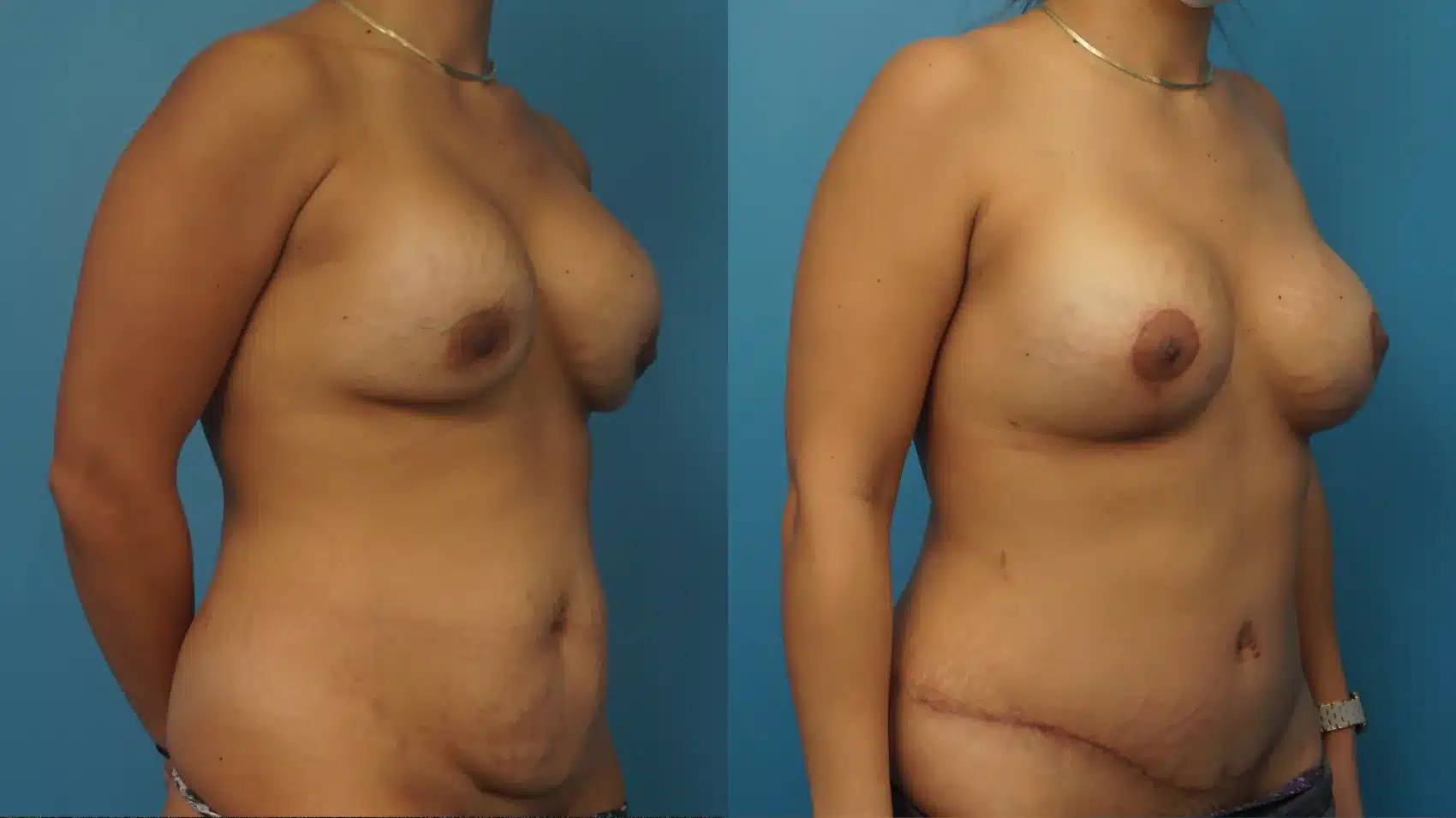 Before and After Image: Revision Breast Augmentation with Lift and Tummy Tuck - right-front-oblique