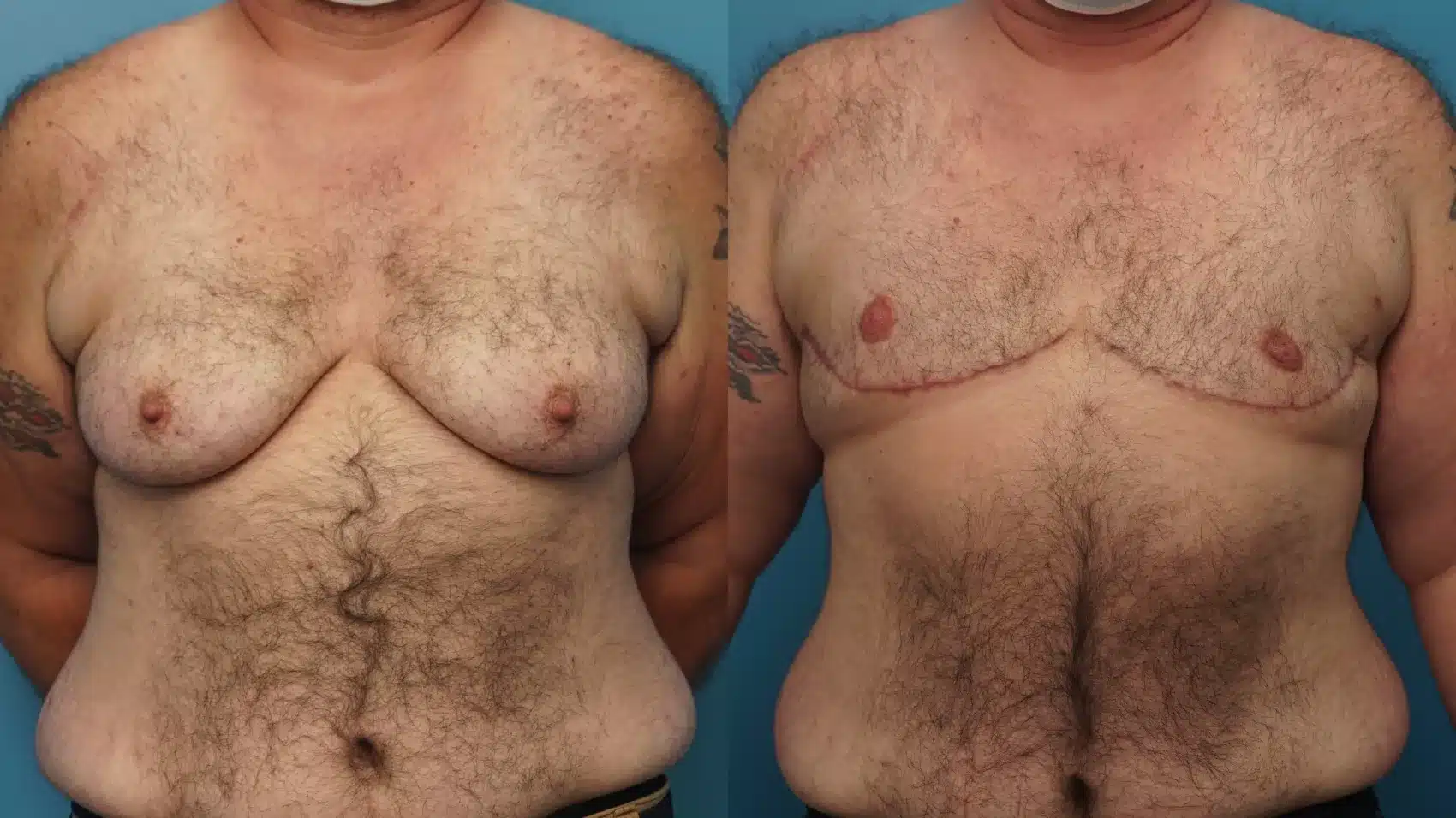 Before and After Image: Case #402 - front