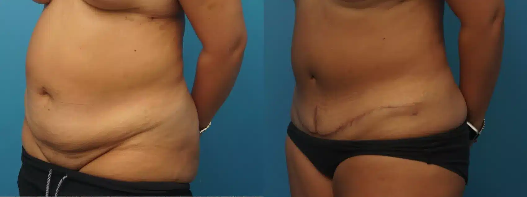Before and After Image: Case #403 - left-front-oblique