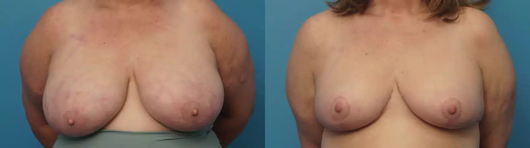 Before and After Image: Case #404 - front