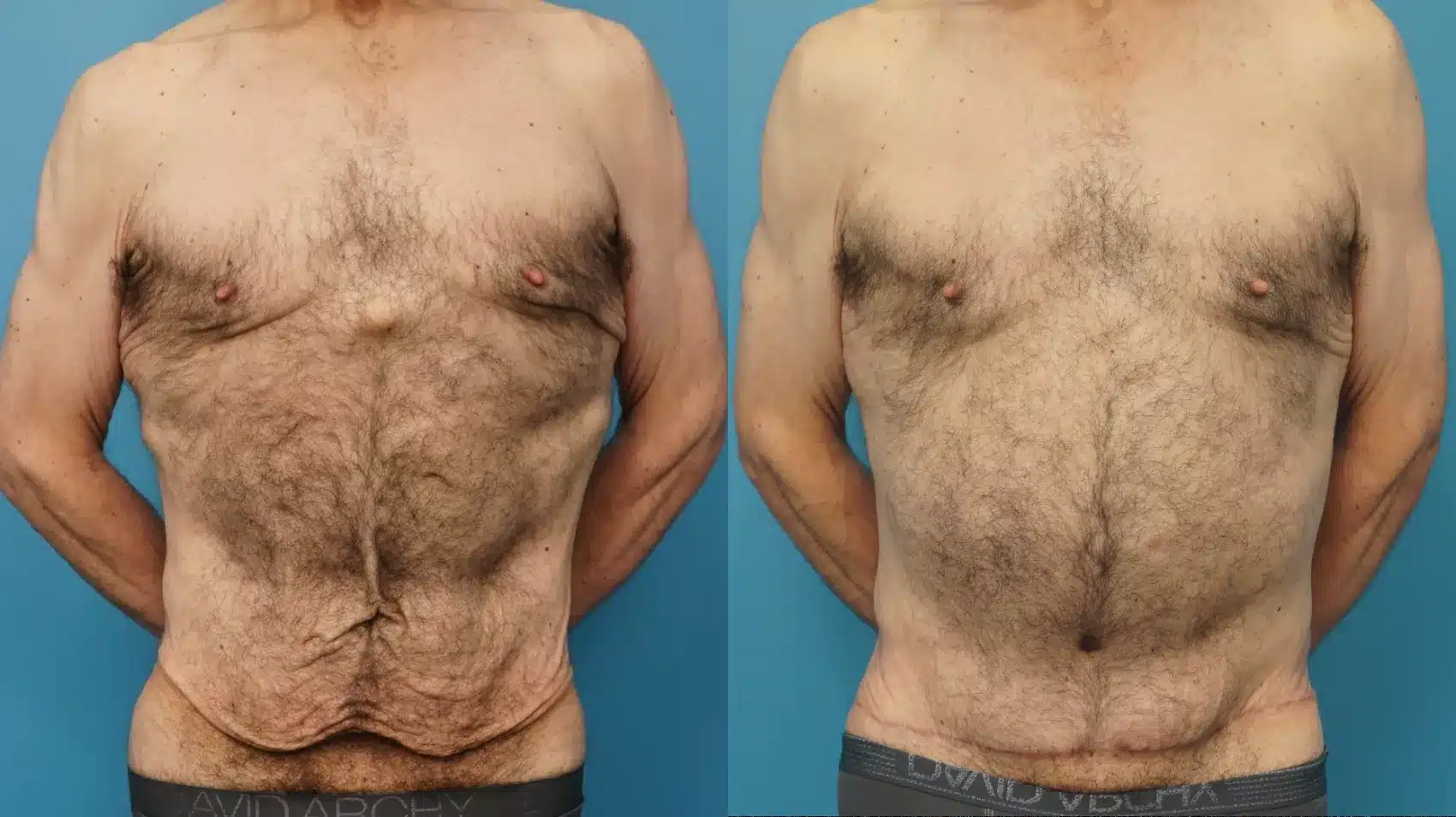 Before and After Image: Case #405 - front