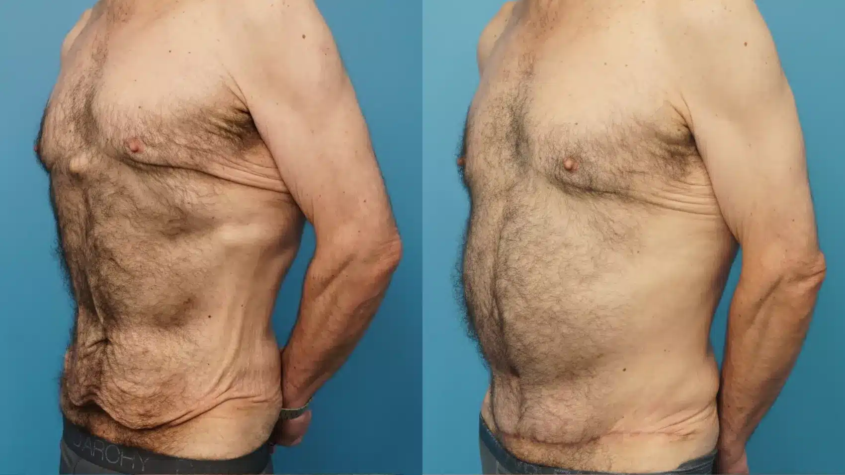 Before and After Image: Case #405 - left-front-oblique