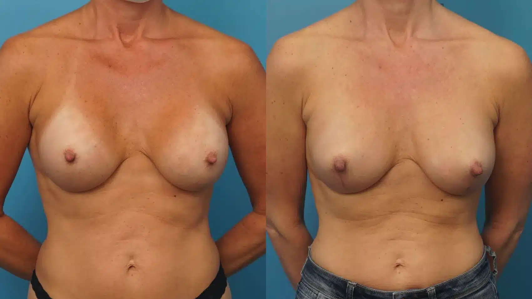 Before and After Image: Breast Implant Exchange with Lower Breast Lift - front