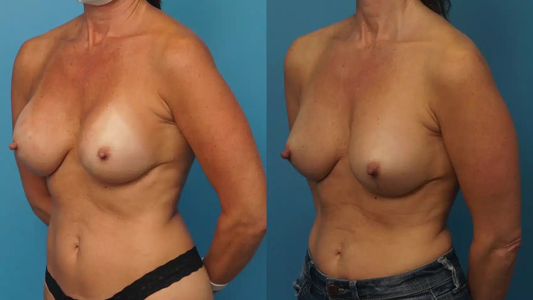 Before and After Image: Breast Implant Exchange with Lower Breast Lift - left-front-oblique