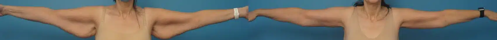 Before and After Image: Arm Lift - front