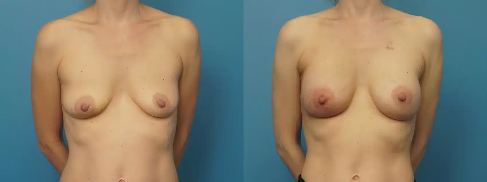 Before and After Image: Case #408 - front