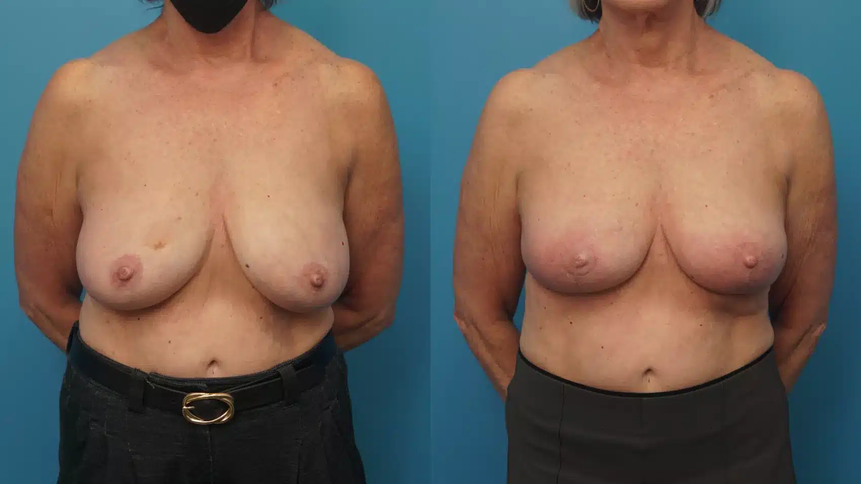 Before and After Image: Case #409 - front