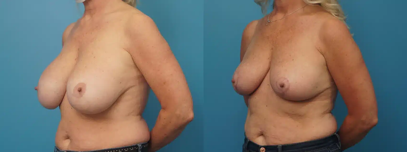 Before and After Image: Breast Implant Removal with Lift - left-front-oblique