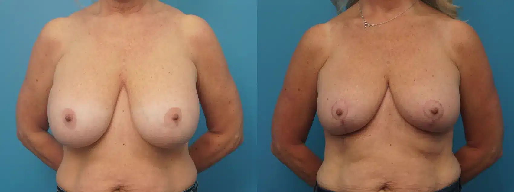Before and After Image: Breast Implant Removal with Lift - front