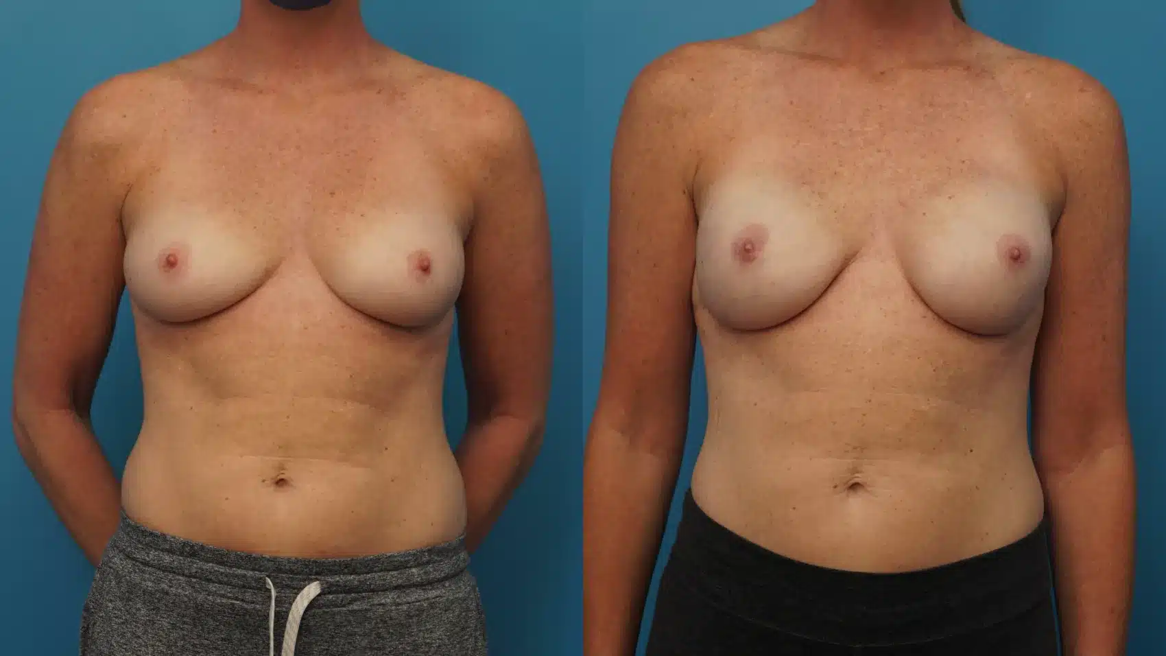 Before and After Image: Breast Reconstruction with Implants - front