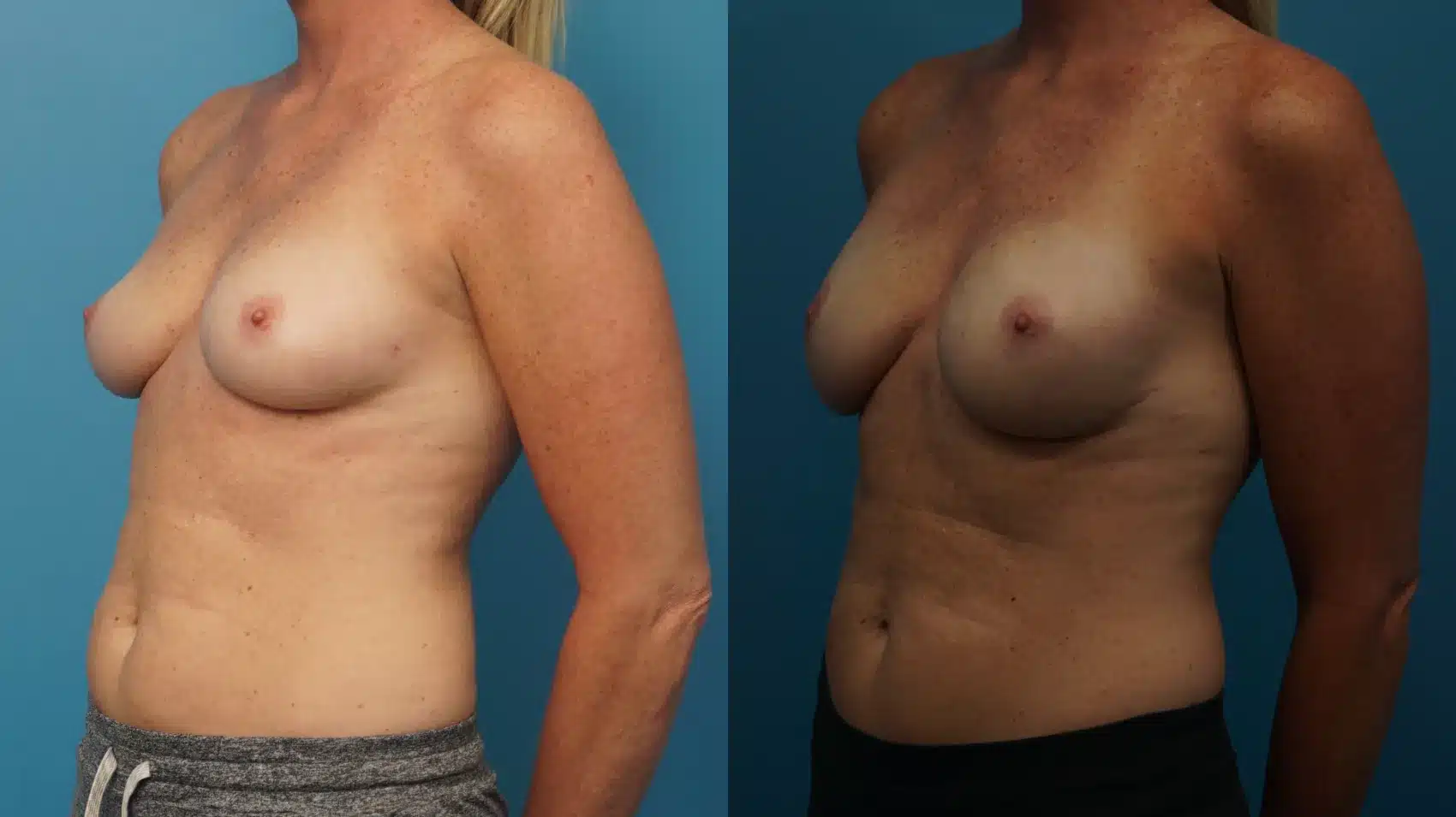 Before and After Image: Breast Reconstruction with Implants - left-front-oblique