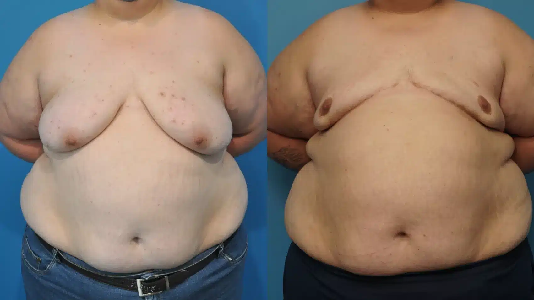 Before and After Image: Case #416 - front