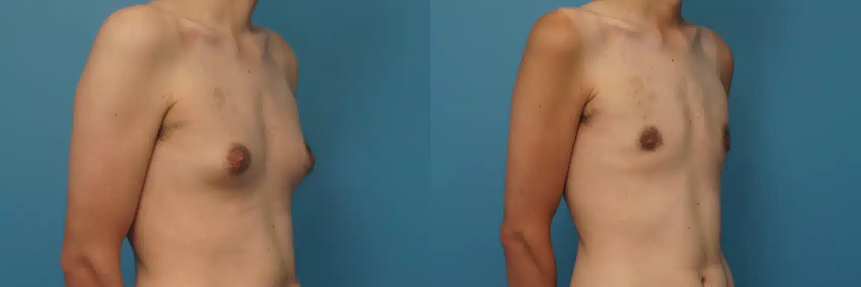 Before and After Image: Male Breast Reduction - right-front-oblique