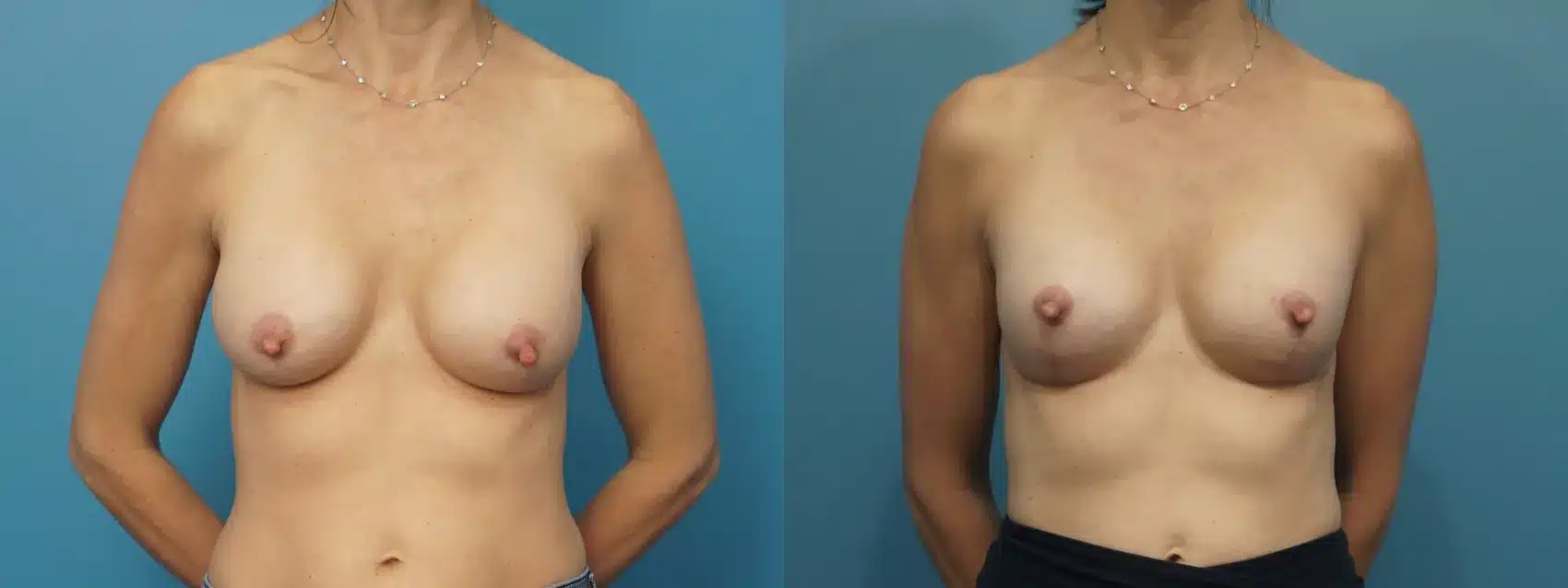 Before and After Image: Breast Implant Down-Sizing with Lift - front