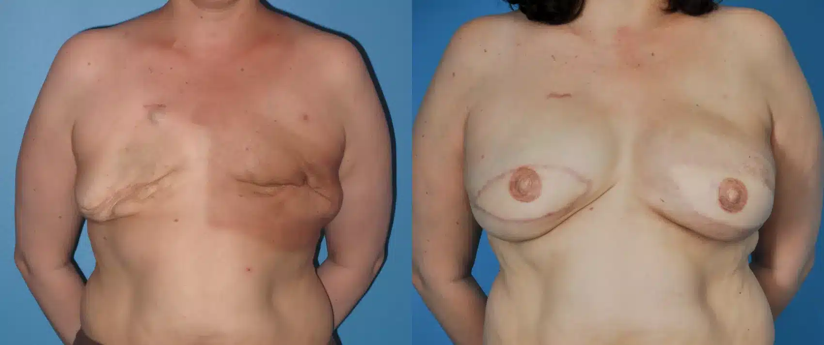 Before and After Image: Case #42 - front