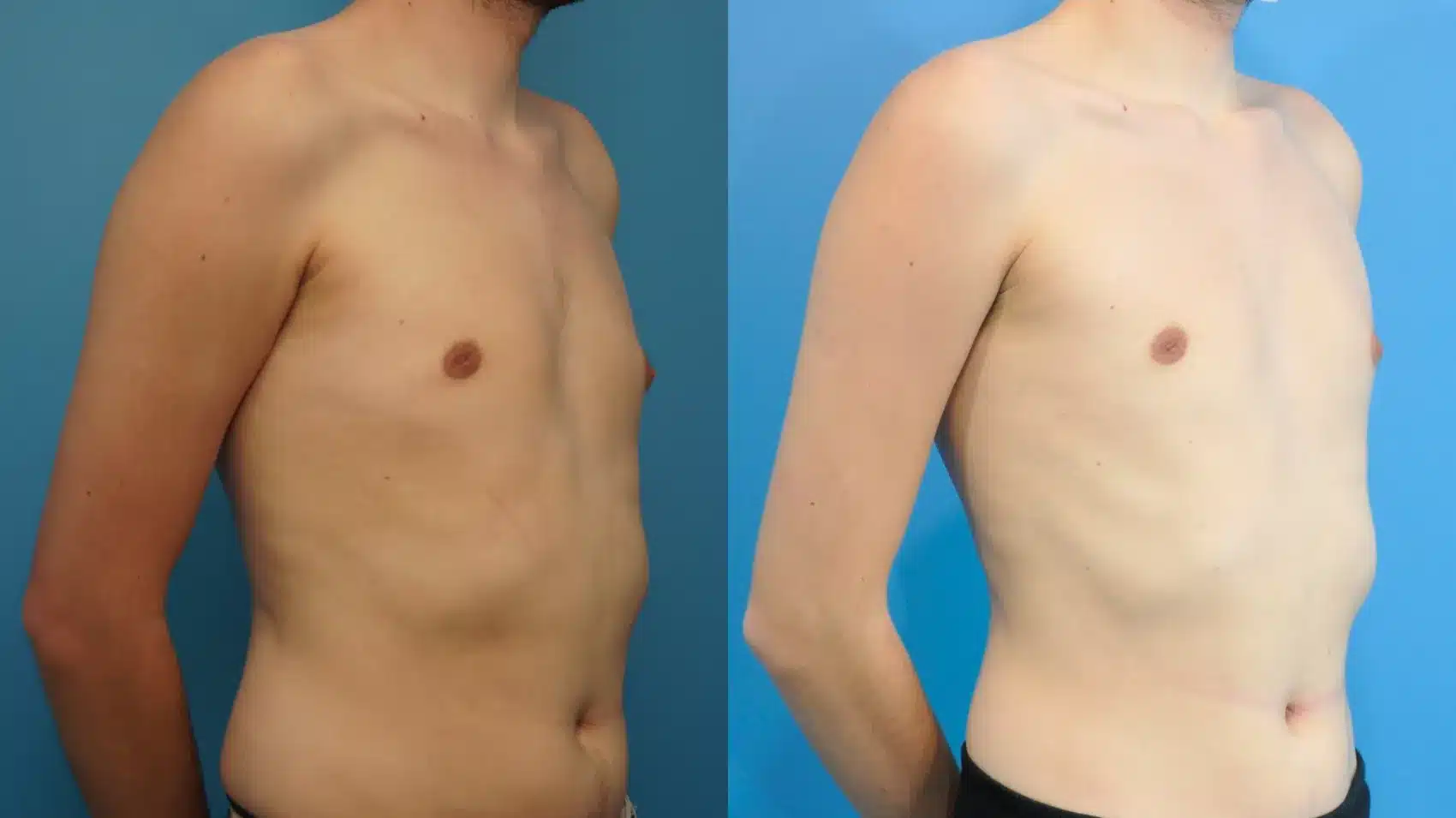 Before and After Image: Male Breast Reduction - right-front-oblique