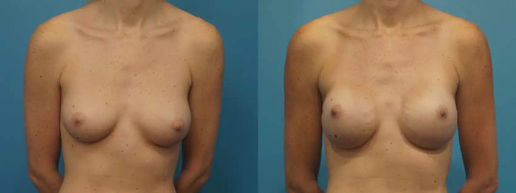 Before and After Image: Robotic Mastectomy with Implant Reconstruction - front