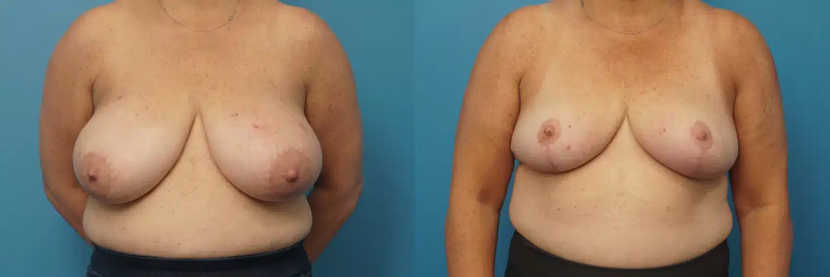 Before and After Image: Case #428 - front