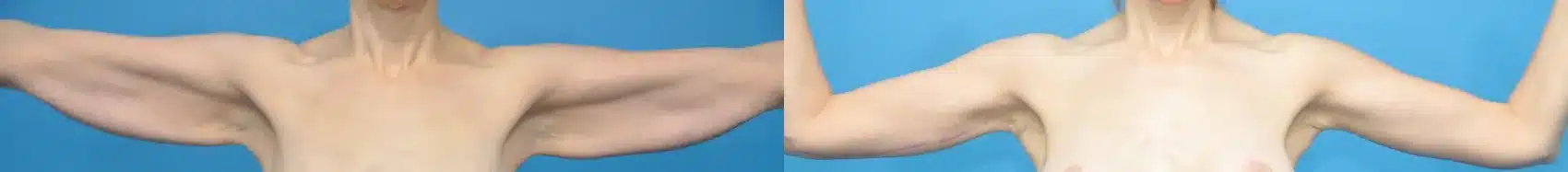 Before and After Image: Brachioplasty - front