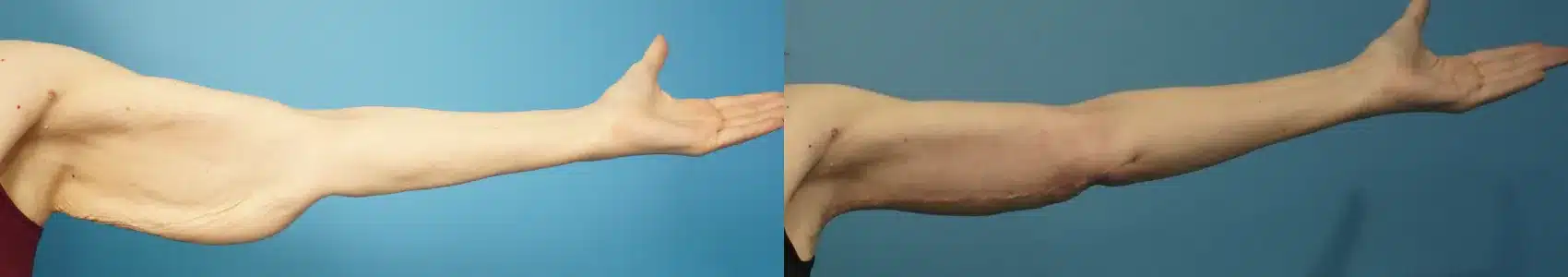 Before and After Image: Brachioplasty (Arm Lift) - front