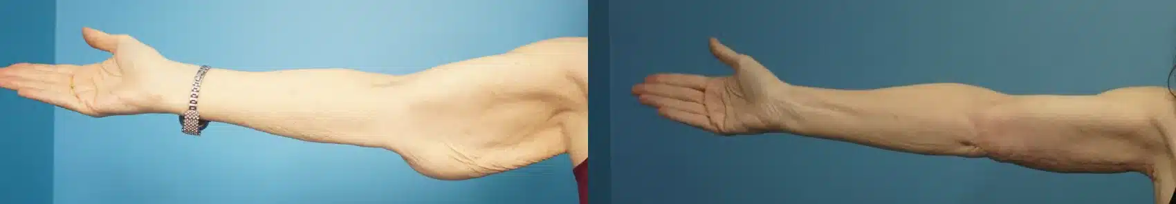 Before and After Image: Brachioplasty (Arm Lift) - front