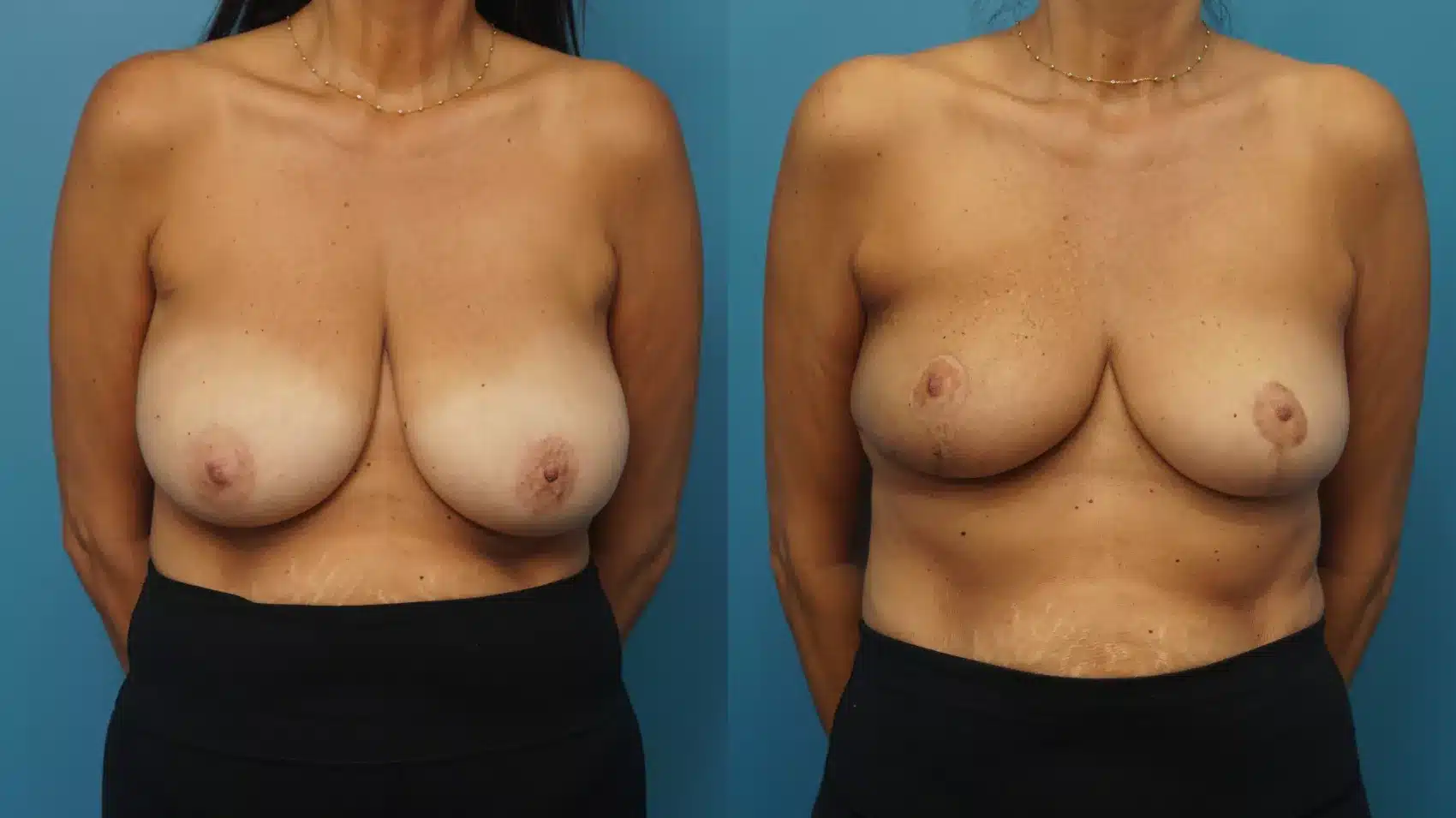 Before and After Image: Case #435 - front