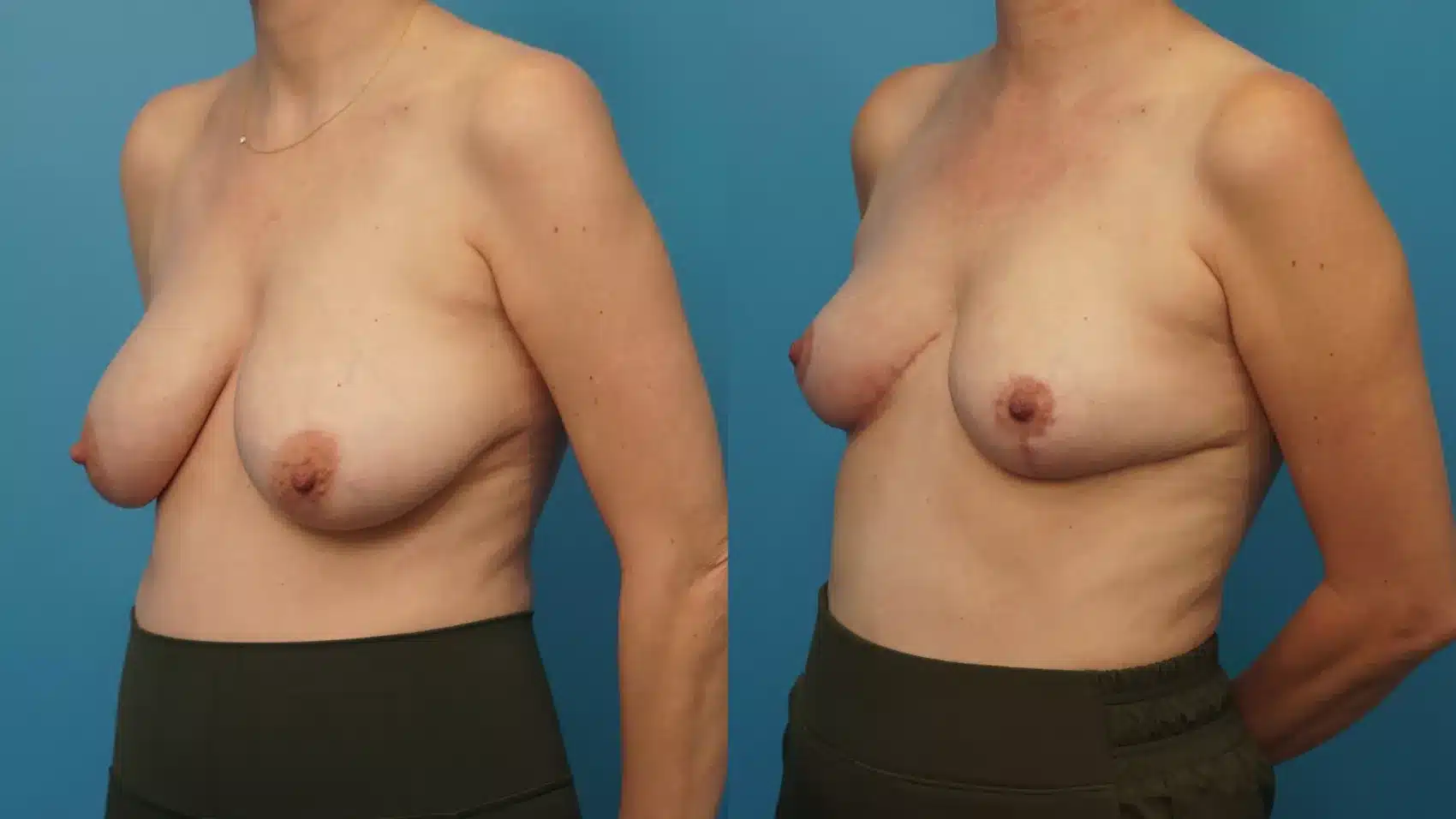 Before and After Image: Case #436 - left-front-oblique