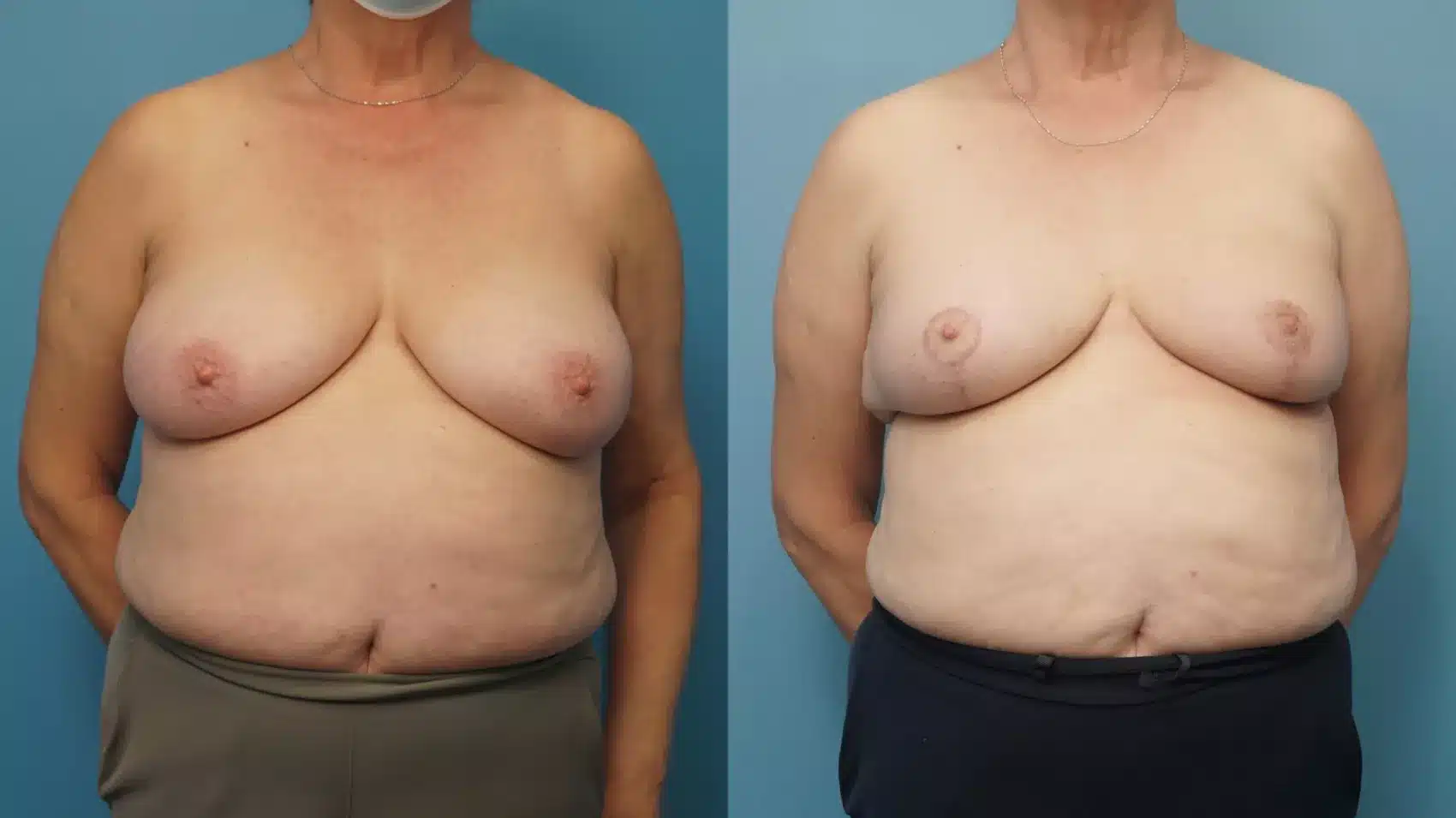 Before and After Image: Case #437 - front