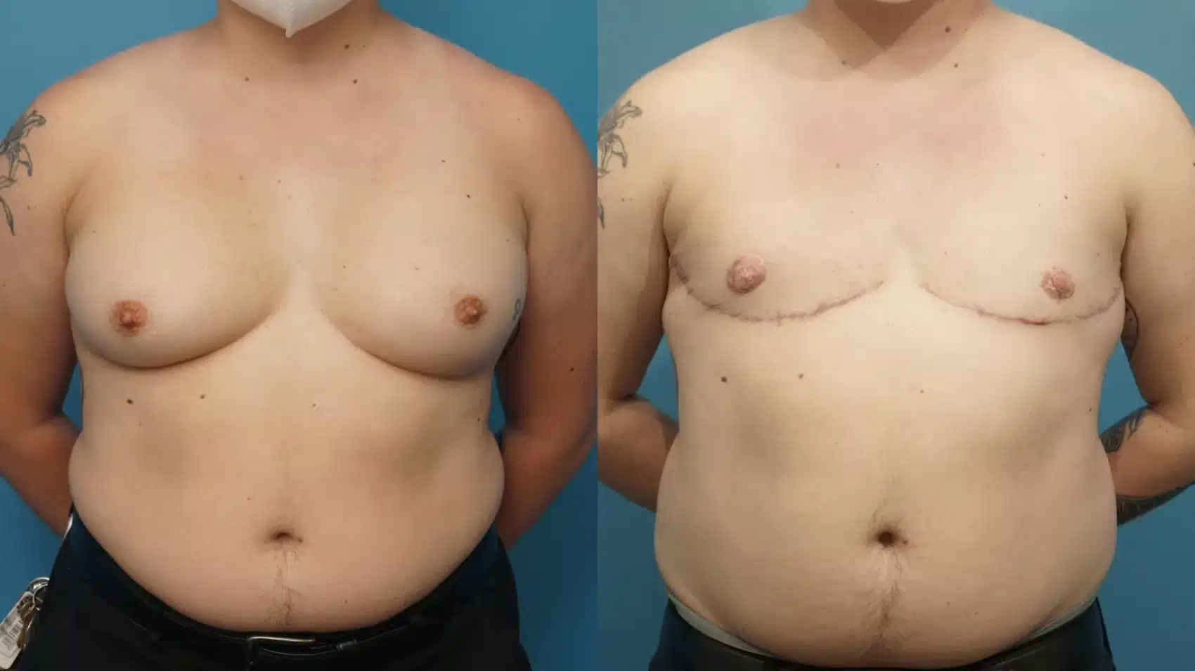 Before and After Image: Case #438 - front